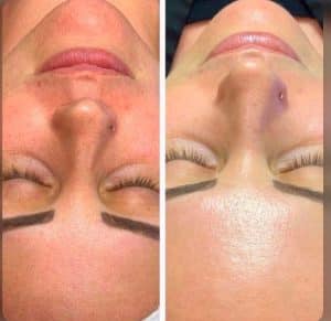 Hydrafacial Biozen Contenu2